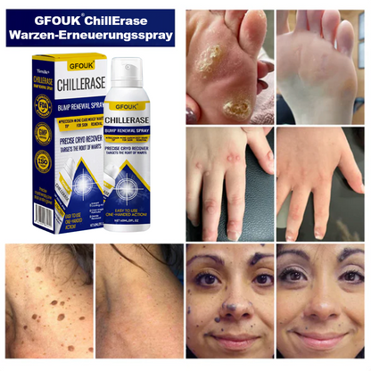 ChillErase Spray zur Pickel- und Hauterneuerung